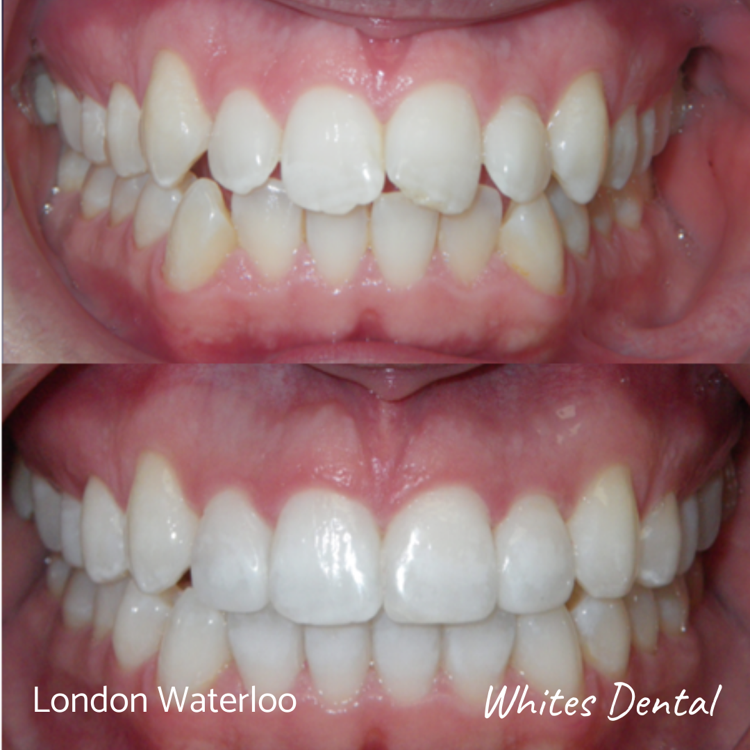 Invisalign braces before and after Whites Dental in London Waterloo | Whites Dental