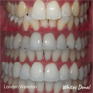 Invisalign braces before after | Orthodontist in London Waterloo 4 | Whites Dental