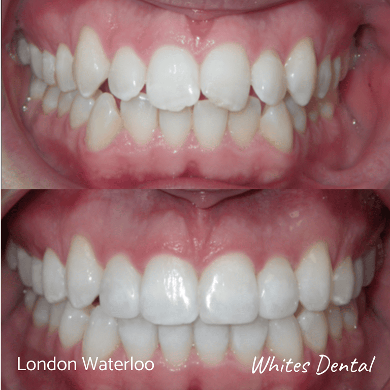 Fixed braces before and after Whites Dental in London Waterloo | Whites Dental