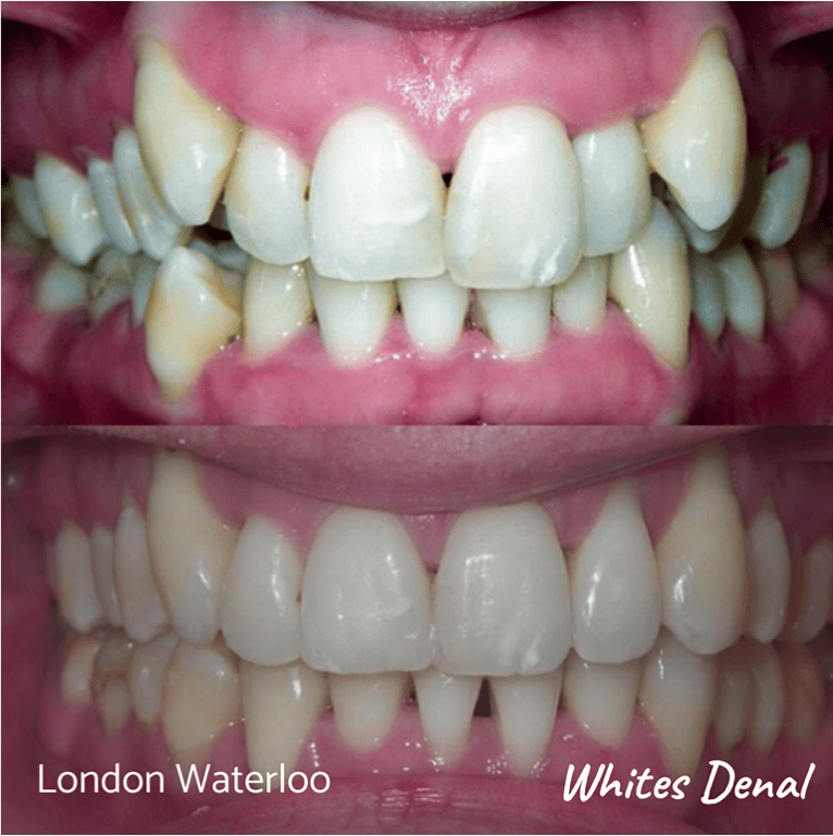 Fixed dental braces before after | Orthodontist in London Waterloo 8 | Whites Dental