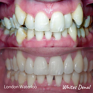 Composite Bonding Cost in Southwark | Cosmetic Dentist in London Waterloo | Whites Dental