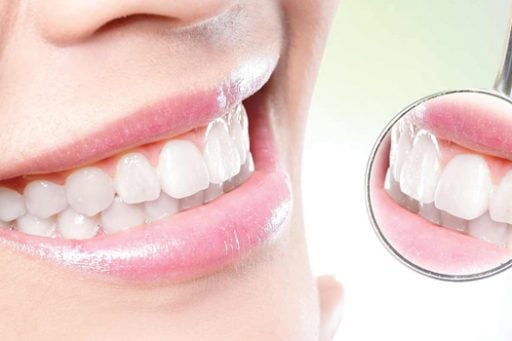 Smile Makeover | Whites Dental