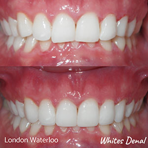 should you consider using adult braces london orthodontic braces & iInvisalign in london | Whites Dental