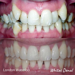 how to find a good invisalign dentist in london orthodontic braces & iInvisalign in london | Whites Dental