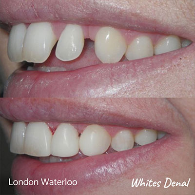 Does Composite Bonding Damage Teeth? | Whites Dental