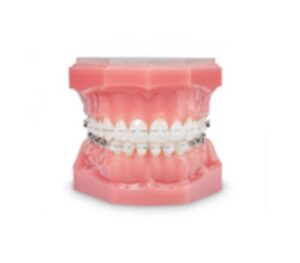 photo of fixed braces with ceramic brackets