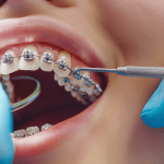 woman wearing fixed metal braces having an adjustment made to the incisor tooth bracket