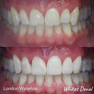 are veneers done in one day cosmetic dentist in london | Whites Dental