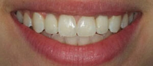 Dental Alignment | Whites Dental