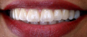 Dental Teeth Alignment | Whites Dental