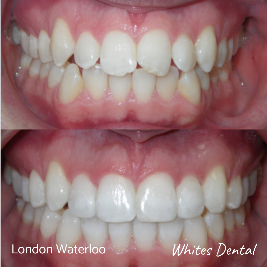 Is It Safe to Use Teeth Whitening While Wearing Braces?