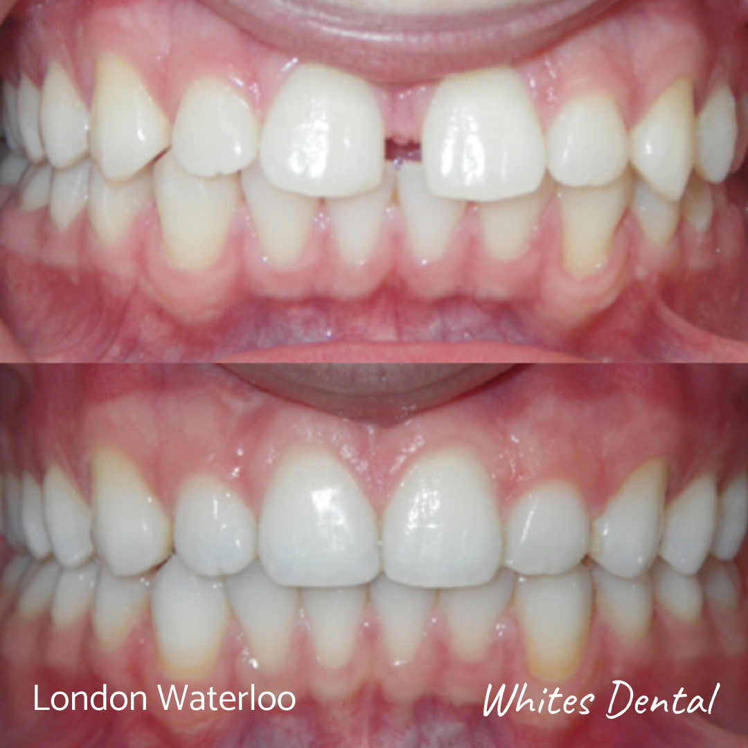 https://www.whitesdental.co.uk/wp-content/uploads/2020/11/orthodontic-braces-invisalign-in-london.png