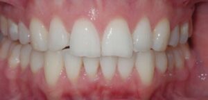 Patient’s teeth after Invisalign in London. Invisalign consultation was free for the patient. First case