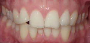 Patient’s teeth prior to Invisalign in London. Invisalign consultation was free for the patient. First case.