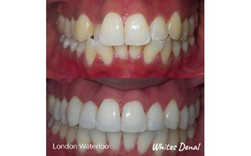 orthodontist london waterloo | Fixed Braces in London | Whites Dental