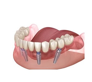 Dental Implant London Waterloo | Whites Dental