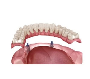 Dental Implant London Waterloo | Whites Dental