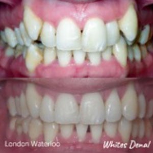 Orthodontic Braces & Invisalign In London | Whites Dental