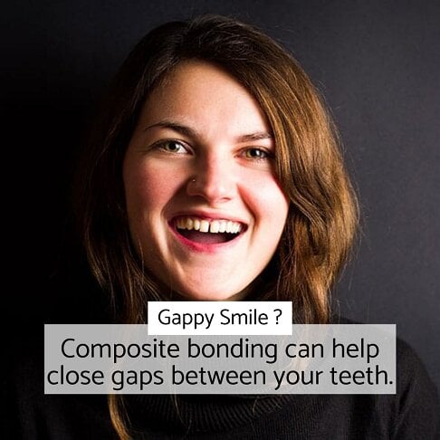 Composite Bonding in London to close teeth gaps