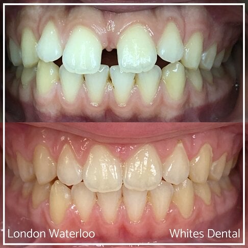 Successful Invisalign Teeth Gap Before and After Results in London Waterloo and Marble Arch - Case Study 11