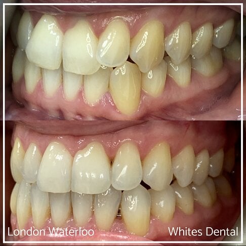 Successful Invisalign Overcrowding Before and After Results in London Waterloo and Marble Arch - Case Study 11