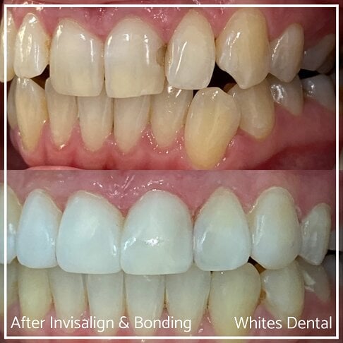 Successful Invisalign Worst Cases Before and After Results in London Waterloo and Marble Arch - Case Study 12