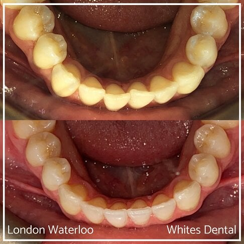 Successful Invisalign Overcrowding Before and After Results in London Waterloo and Marble Arch - Case Study 22