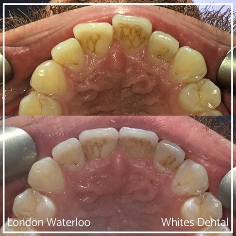 Successful Invisalign Overcrowding Before and After Results in London Waterloo and Marble Arch - Case Study 23