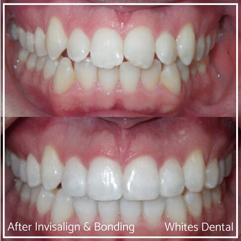 Successful Invisalign Worst Cases Before and After Results in London Waterloo and Marble Arch - Case Study 3