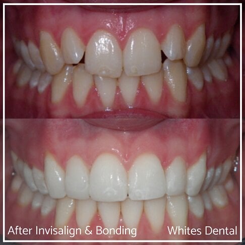 Successful Invisalign Overbite and Underbite Before and After Results in London Waterloo and Marble Arch - Case Study 6