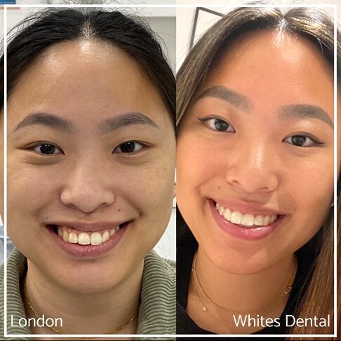 Successful Invisalign Transformation Before and After in London Waterloo and Marble Arch - Case Study 1