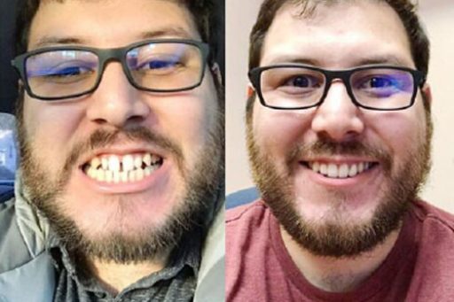 Invisalign Gap Teeth London UK | Whites Dental