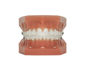 orthodontist pricing photo of fast braces | Whites Dental