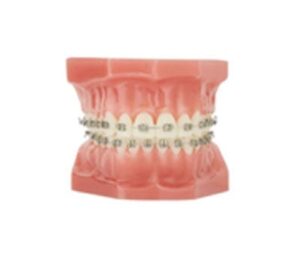 orthodontist pricing photo and model of metal braces | Whites Dental