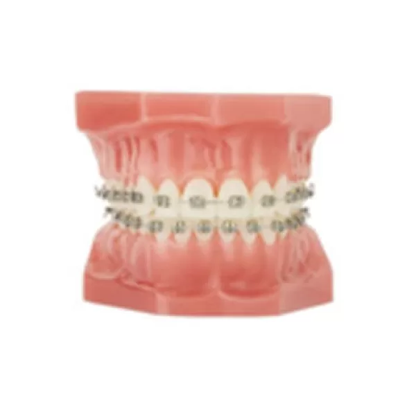 orthodontist pricing photo and model of metal braces | Whites Dental