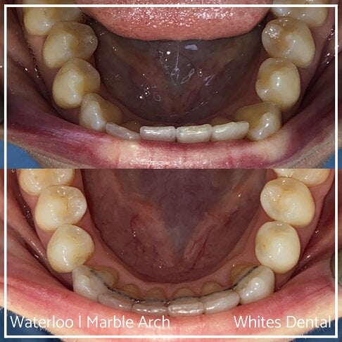 photo showing bottom row of teeth before and during braces treatment