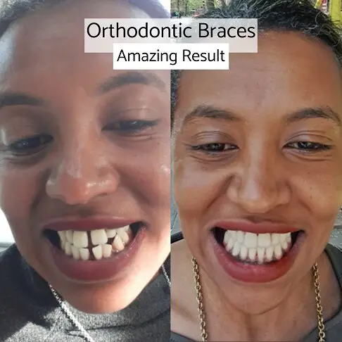 Fixed braces before and after results