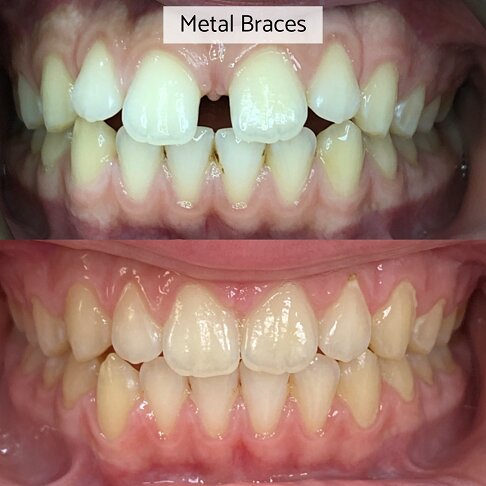 Metal braces cost London