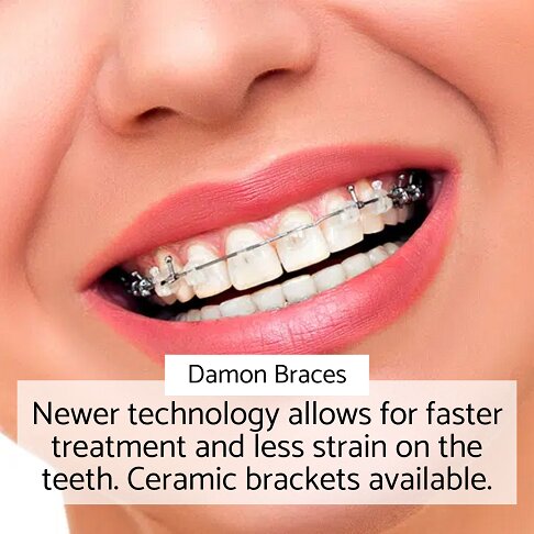 Adult Braces - Damon braces - newer technology to straighten teeth