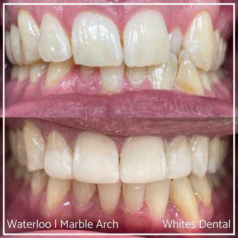 Braces Before And After - Photo of teeth after treatment for crossbite 2