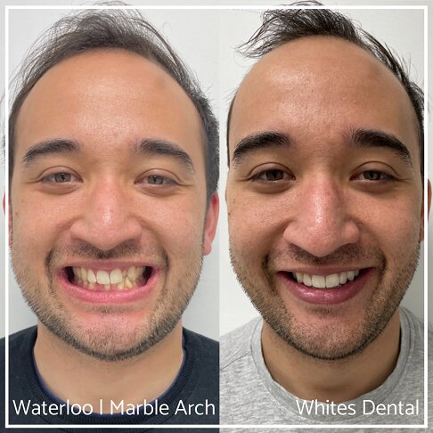 Braces Before And After - Adult Braces for crossbite