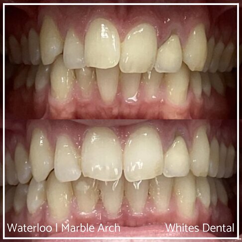 Braces Before And After - photo of teeth - front - crowded teeth
