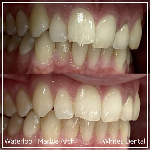 Braces Before And After - photos of treatment results - side/front - for overlapping teeth 2