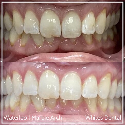 Braces Before And After - Adult Braces for overlapping teeth