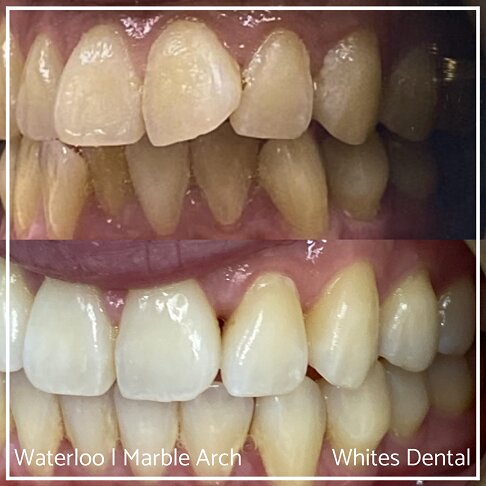 Braces Before And After - photo of teeth front Openbite 1