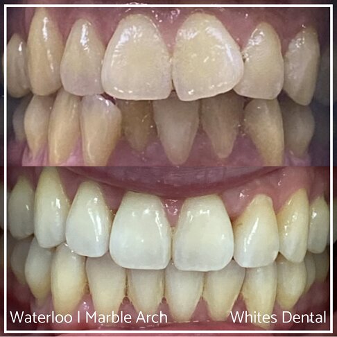 Braces Before And After - photo of teeth - front for Openbite 2