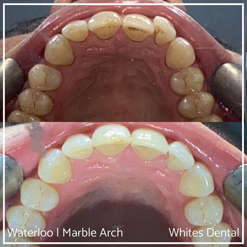 Braces Before And After - photo of teeth top row, inside - for Openbite 3