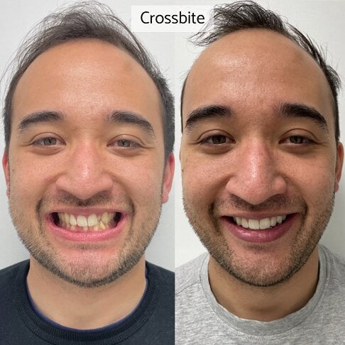 Braces London - middle age man with crossbite