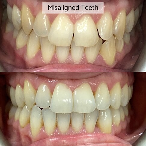 Braces London - misaligned teeth