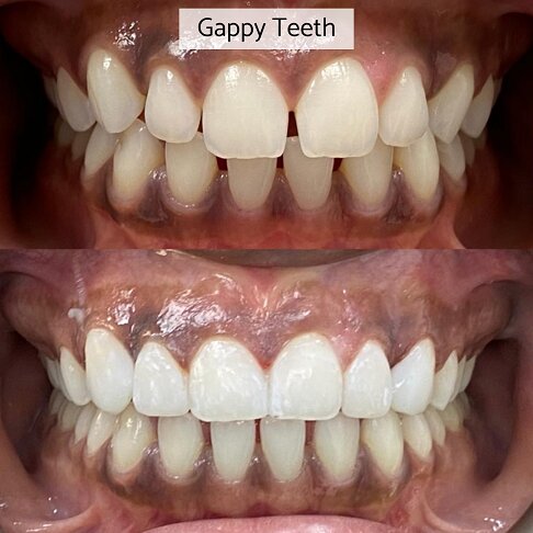 Composite Bonding Cost London - Gappy Teeth